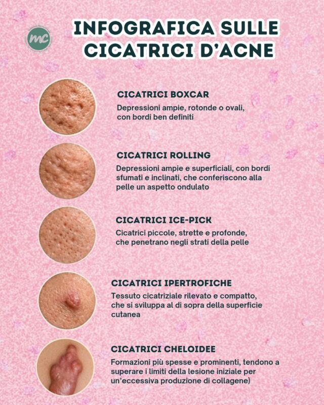 INFOGRAFICA SULLE CICATRICI D'ACNE ⚠️
Le cicatrici d'acne sono una delle conseguenze più comuni dell’acne infiammatoria e NON sono tutte uguali. 

Le più comuni sono le CICATRICI ATROFICHE:

- cicatrici ICE PICK (cicatrici strette, profonde e appuntite, simili a piccoli “fori” nella pelle. Penetrano verticalmente nel derma)
- cicatrici BOXCAR (depressioni più larghe e ben definite, con bordi netti. Possono essere sia superficiali che profonde)
- ROLLING (cicatrici ondulate e irregolari che donano alla pelle un aspetto “a onde”, dovuto a trazioni fibrose del derma)

Poi ci sono anche le CICATRICI IPERTROFICHE (cicatrici rilevate ed ispessite che rimangono entro i margini della lesione originaria) e le CICATRICI CHELOIDEE (più spesse e prominenti, tendono a superare i limiti della lesione iniziale per un’eccessiva produzione di collagene).

COSA FARE❓Ogni cicatrice presenta caratteristiche differenti e necessita quindi di un trattamento specifico e personalizzato:
riconoscerle correttamente è fondamentale quindi per scegliere poi la terapia più adatta a trattarle.

PROCEDURE TERAPEUTICHE INNOVATIVE PERCORSO ACNE E RIMOZIONE CISTI SEBACEE DOTT.SSA MARINA CONESE™