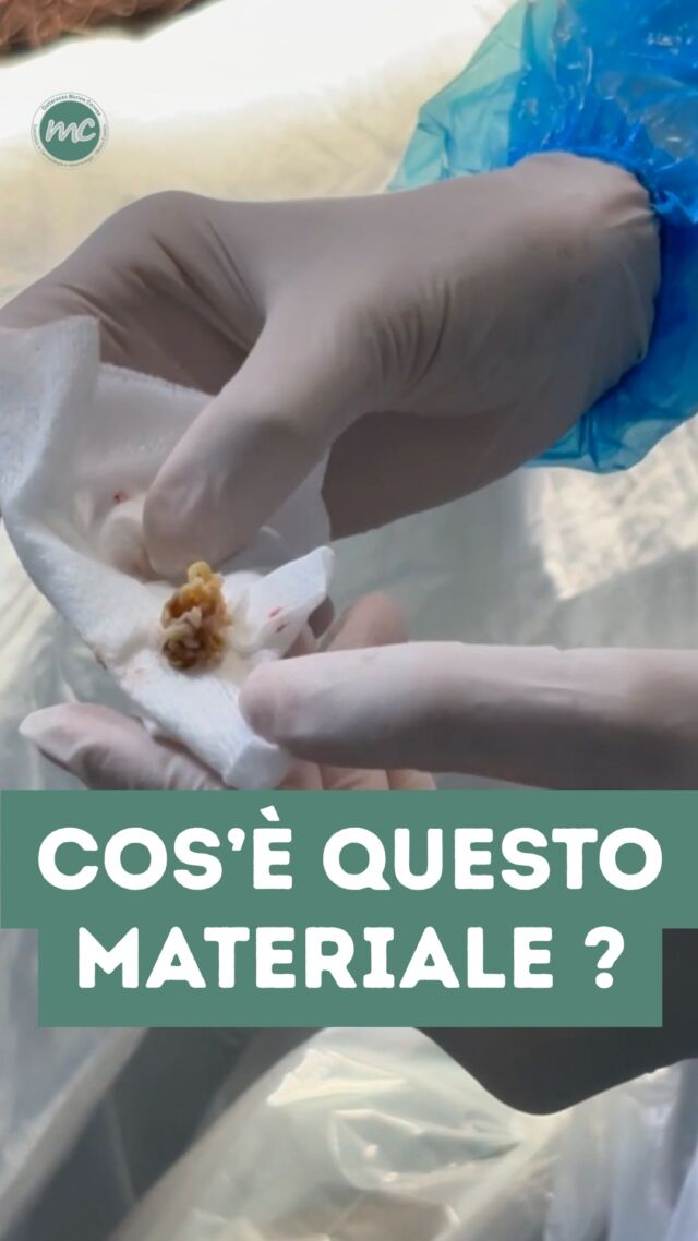 Guardate quanto materiale è fuoriuscito da questa CISTI ! 
Ma la situazione non va sottovalutata... 🤔 

Il materiale contenuto al suo interno si potrebbe anche infettare, trasformandosi così in pus e dando origine ad una cisti purulenta. Con infiammazione, dolore e possibili complicanze...

Non aspettate a far attenzione una CISTI ! Io vi aspetto in Studio 🫶

PROCEDURE TERAPEUTICHE INNOVATIVE PERCORSO ACNE E RIMOZIONE CISTI SEBACEE DOTT.SSA MARINA CONESE™

📍Via Raffaele De Cesare 15, Bari
📞 𝟥𝟩𝟨 𝟣𝟣𝟧𝟣𝟪𝟤𝟨 (acne) / 𝟥𝟦𝟪 𝟨𝟣𝟢𝟥𝟦𝟨𝟣
☎️ 𝟢𝟪𝟢 𝟩𝟫𝟨𝟥𝟥𝟦𝟫

#dottssamarinaconese #dermatologia #new #cisti #influencer #bari #puglia