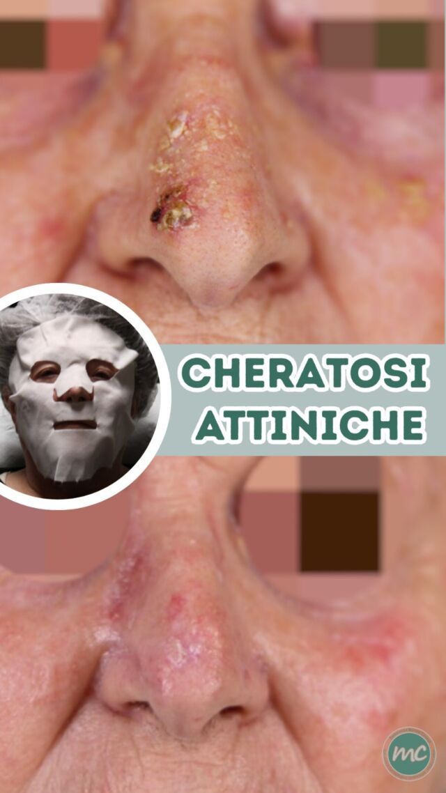 CHERATOSI ATTINICHE: DI COSA SI TRATTA ❓
Le cheratosi attiniche sono delle lesioni cutanee causate principalmente dall'esposizione cronica ai raggi ultravioletti (UV) del sole o delle lampade abbronzanti.
Sono considerate lesioni precancerose: alcune possono evolvere in un carcinoma squamocellulare, una forma di tumore della pelle. 

Per questo è importante una valutazione dermatologica e quando indicato un trattamento adeguato.

COME LE TRATTO ❓
Dopo il decapaggio delle lesioni e l’applicazione topica dell’ALA (acido 5-aminolevulinico), il fotosensibilizzante utilizzato nella terapia fotodinamica,  la paziente ha eseguito infine delle sedute di Fotobiomodulazione con luce blu e rossa insieme ... 

Come potete vedere a distanza di qualche mese, abbiamo ottenuto dei risultati notevoli !

📍Via Raffaele De Cesare 15, Bari
📱 𝟥𝟩𝟨 𝟣𝟣𝟧𝟣𝟪𝟤𝟨 (acne) / 𝟥𝟦𝟪 𝟨𝟣𝟢𝟥𝟦𝟨𝟣
☎️ 𝟢𝟪𝟢 𝟩𝟫𝟨𝟥𝟥𝟦𝟫

#dottssamarinaconese #dermatologia #influencer #bari #puglia #new
