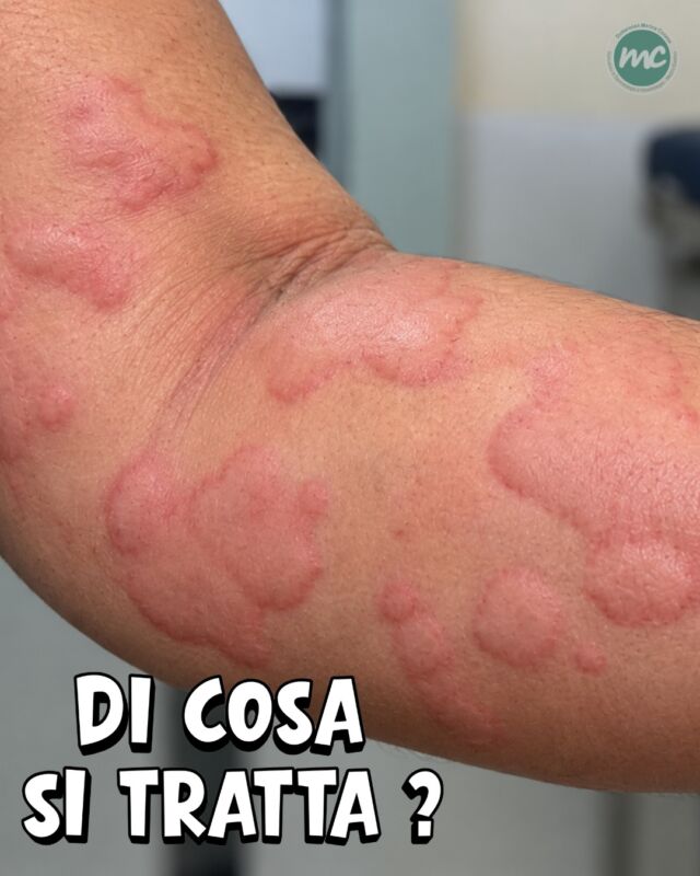 CASO CLINICO 🔎👀
Pomfi caratteristicamente fugaci, arrossati, prurito e lesioni cutanee comparse improvvisamente... 

DI COSA SI TRATTA❓ORTICARIA 
L’orticaria è una condizione infiammatoria della pelle caratterizzata appunto dalla comparsa improvvisa di pomfi caratteristicamente fugaci, in rilievo (arrossati o biancastri) accompagnati da intenso prurito o talvolta bruciore.

Può essere ACUTA o CRONICA a seconda della durata e dei sintomi: 

- ACUTA dura fino a 6 settimane, spesso scatenata anche da reazioni allergiche (cibi, farmaci, punture di insetti) o da infezioni virali/batteriche

- CRONICA persiste per più di 6 settimane e può essere spontanea (cioè senza un fattore scatenante evidente o su base autoimmune) oppure inducibile da stimoli come freddo, caldo, pressione o sfregamento

COSA FARE 🤔
È importante rivolgersi al vostro Dermatologo di fiducia per valutare le possibili cause ed individuare il trattamento più idoneo.

Nelle acuzie, la terapia si basa sull’utilizzo di corticosteroidi ed antistaminici per brevi periodi. Nei casi di orticaria cronica persistente, la terapia si basa principalmente sui farmaci biologici.
 
Il principale farmaco biologico per l'orticaria cronica spontanea refrattaria agli antistaminici, è l' Omalizumab (un anticorpo monoclonale anti-IgE somministrato per via sottocutanea). Altre opzioni includono Dupilumab e terapie emergenti come Remibrutinib.

📍Via Raffaele De Cesare 15, Bari
📞 𝟥𝟩𝟨 𝟣𝟣𝟧𝟣𝟪𝟤𝟨 (acne) / 𝟥𝟦𝟪 𝟨𝟣𝟢𝟥𝟦𝟨𝟣
☎️ 𝟢𝟪𝟢 𝟩𝟫𝟨𝟥𝟥𝟦𝟫

#dottssamarinaconese #dermatologia #new #influencer #bari #puglia #new
