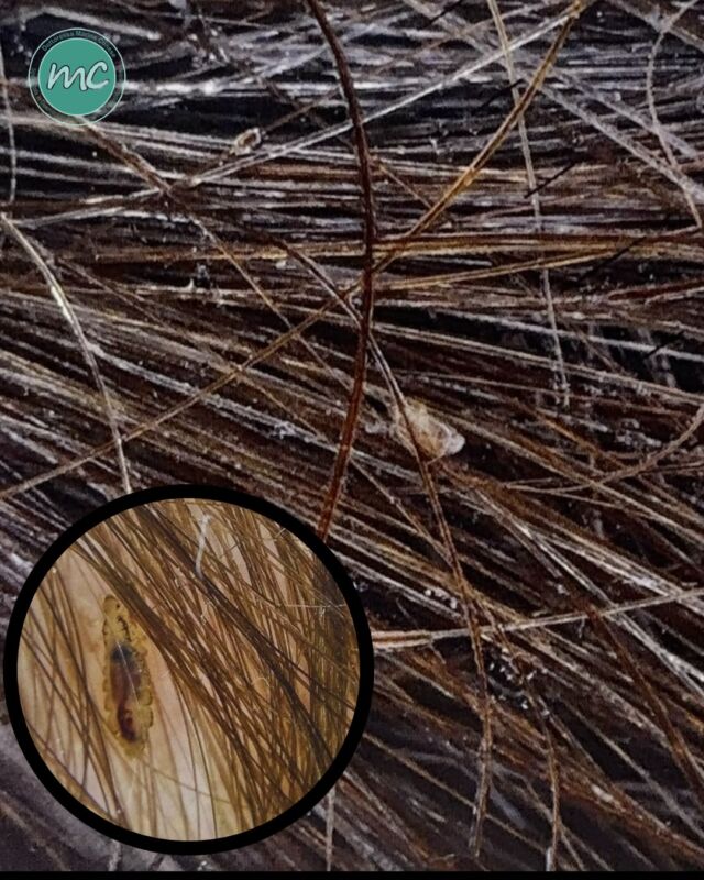 Prurito al cuoio capelluto e piccole strutture aderenti ai capelli… DI COSA SI TRATTA❓

La PEDICULOSI DEL CAPO è un’infestazione del cuoio capelluto causata da piccoli insetti parassiti chiamati Pediculus humanus capitis (comunemente noti come pidocchi). 
Si manifesta con prurito, che può comparire anche alcune settimane dopo l’inizio dell’infestazione. 🪳

COME RICONOSCERLA 🔎
La diagnosi si basa soprattutto sull’individuazione dei pidocchi o delle lendini (le uova, che appaiono come piccoli corpi biancastri o traslucidi) adese al fusto del capello e difficili da rimuovere.

La dermatoscopia può aiutare a riconoscere le lendini e a distinguerle da squame, residui di prodotti per capelli e altre strutture che possono essere confuse con esse.

COME SI TRASMETTE❓
Principalmente attraverso il contatto diretto testa a testa, soprattutto tra i bambini oppure tramite la condivisione di oggetti personali come pettini, spazzole, cappelli e sciarpe (una modalità meno frequente).

COSA FARE 🤔
In caso di infestazione è importante utilizzare un trattamento specifico contro questi "piccoli e fastidiosi ospiti", disponibile in farmacia, e seguire attentamente le istruzioni.

Alcuni trattamenti devono essere ripetuti dopo un intervallo specifico: è importante attenersi alle terapie prescritte e consigli dello specialista. 

Un’ultima cosa: 
⚠️ LA PEDICULOSI NON È LEGATA ALLA SCARSA IGIENE PERSONALE E PUÒ COLPIRE CHIUNQUE: BISOGNA SEMPRE RIVOLGERSI AL PROPRIO SPECIALISTA DERMATOLOGO DI FIDUCIA SOPRATTUTTO SE SI HANNO SOSPETTI  DI ESSERE STATO CONTAGIATO PER NON DIVENTARE UNTORI ! ⚠️

📍Via Raffaele De Cesare 15, Bari
📞 𝟥𝟩𝟨 𝟣𝟣𝟧𝟣𝟪𝟤𝟨 (acne) / 𝟥𝟦𝟪 𝟨𝟣𝟢𝟥𝟦𝟨𝟣
☎️ 𝟢𝟪𝟢 𝟩𝟫𝟨𝟥𝟥𝟦𝟫

#dottssamarinaconese #dermatologia #influencer #bari #puglia #new