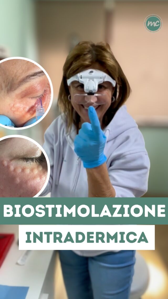 BIOSTIMOLAZIONE✨ 
Un trattamento di intradermoterapia indicato per migliorare gli esiti dell’acne e la qualità della pelle.

COME ? Attraverso un'iniezione intradermica di vitamine, acido ialuronico, aminoacidi e altri composti favorendo così i processi di rinnovamento cutaneo e contribuendo a rendere la pelle più uniforme, luminosa e idratata.

Durante il trattamento si formano dei piccoli POMFI, volutamente creati per consentire il rilascio graduale dell’acido ialuronico non reticolato. Questi si riassorbono spontaneamente nell’arco di poche ore.

 Riuscite a riconoscere chi si è sottoposta al trattamento? 👀😄

📍Via Raffaele De Cesare 15, Bari
📞 𝟥𝟩𝟨 𝟣𝟣𝟧𝟣𝟪𝟤𝟨 (acne) / 𝟥𝟦𝟪 𝟨𝟣𝟢𝟥𝟦𝟨𝟣
☎️ 𝟢𝟪𝟢 𝟩𝟫𝟨𝟥𝟥𝟦𝟫

#dottssamarinaconese #dermatologia #medicinaestetica #influencer #bari #puglia #new