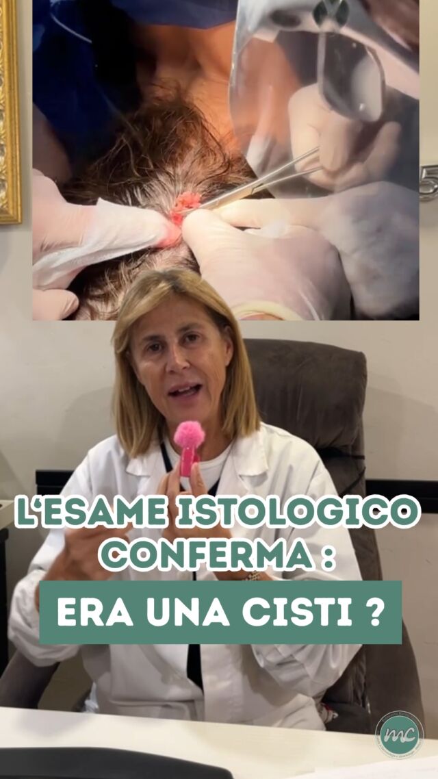 Vi ricordate la rimozione CISTI dell'altra settimana, in cui solo DOPO aver RIMOSSO la capsula fibrosa ABBIAMO SCOPERTO l’esistenza di una sorta di “SACCO” CONTENENTE TANTE altre PICCOLE CISTI❓👀

Ho subito pensato si trattasse di uno SPIROADENOMA ECCRINO e non di una classica CISTI del cuoio capelluto. 

Ora finalmente è arrivato il risultato dell’ESAME ISTOLOGICO, che ci ha permesso di arrivare alla diagnosi definitiva… 🤔

PROCEDURE TERAPEUTICHE INNOVATIVE PERCORSO ACNE E RIMOZIONE CISTI SEBACEE DOTT.SSA MARINA CONESE™

📍Via Raffaele De Cesare 15, Bari
📞 𝟥𝟩𝟨 𝟣𝟣𝟧𝟣𝟪𝟤𝟨 (acne) / 𝟥𝟦𝟪 𝟨𝟣𝟢𝟥𝟦𝟨𝟣
☎️ 𝟢𝟪𝟢 𝟩𝟫𝟨𝟥𝟥𝟦𝟫

#dottssamarinaconese #dermatologia #new #cisti #influencer #bari #puglia