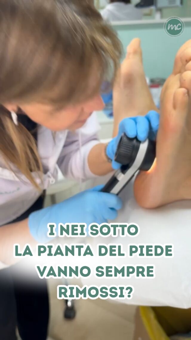 I NEI SOTTO LA PIANTA DEL PIEDE... SONO PERICOLOSI? 👣

DI COSA SI TRATTA ❓
I nevi acrali sono dei nei benigni localizzati nelle aree “acrali” (cioè i palmi delle mani, la piante dei piedi o sulle dita). 

E' importante valutarli correttamente, senza sottovalutare eventuali cambiamenti, dato che sono nevi situati in zone particolarmente delicate, soggette a pressione e sfregamenti continui. 🔎

Per questo controllare possibili cambiamenti di forma, colore o dimensioni e rivolgersi al vostro Dermatologo di fiducia per una accurata valutazione dermatoscopica è sempre la cosa piu' giusta da fare, quando si ha un dubbio a riguardo. 🫶

📍Via Raffaele De Cesare 15, Bari
📞 𝟥𝟩𝟨 𝟣𝟣𝟧𝟣𝟪𝟤𝟨 (acne) / 𝟥𝟦𝟪 𝟨𝟣𝟢𝟥𝟦𝟨𝟣
☎️ 𝟢𝟪𝟢 𝟩𝟫𝟨𝟥𝟥𝟦𝟫

#dottssamarinaconese #dermatologia #influencer #bari #puglia #new