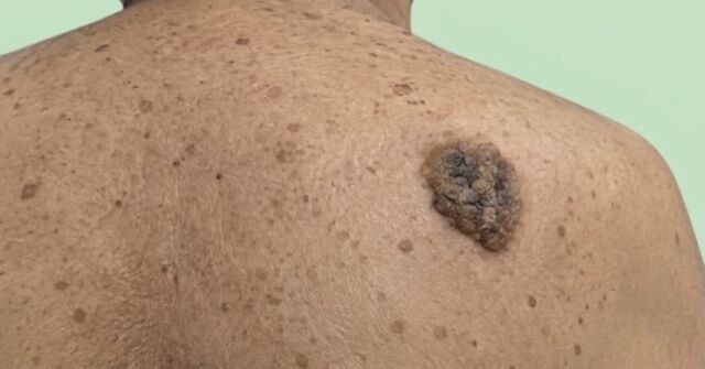 Certe volte si dà più importanza ad una lesione di maggiore dimensioni che non ad una più piccolina che spesso passa quasi inosservata…. 
👉Consiglio: rivolgetevi sempre al vostro dermatologo di fiducia, non giocate a farvi l’autodiagnosi ‼️ 
Potreste solo ritardare ( certe volte con gravi conseguenze ) il vero momento diagnostico e la cura. 
Vi mostro due casi clinici corredati di esame dermatoscopico. 
Ebbene le prime due foto rappresentano una lesione benigna e comune sulla spalla di un uomo : una CHERATOSI SEBORROICA ( KS ) , che non degenera mai e può essere lasciata lì per tutta la vita … (se si toglie è solo per motivi estetico-funzionali e a richiesta del paziente) ;

l’ultima foto, la terza, ( con relativa dermatoscopia ) posta un tumore molto temibile e aggressivo della pelle : un MELANOMA INVASIVO ( rivelatosi poi all’istologia di 0,8 mm ) di diametro inferiore a 3 mm che si trova nell’area poplitea di un giovane ragazzo! Lesione da asportare chirurgicamente il più velocemente possibile con esame istopatologico. 

👉Non è la grandezza un parametro di allert ⛔️
👉Non sfidate la vostra sorte con le autodiagnosi 
👉Il mio consiglio è sempre quello di fare una visita specialistica dermatologica di prevenzione almeno una volta l’anno. 

#dottssamarinaconese #dermatologia #new