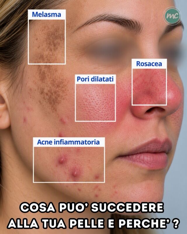 COSA SUCCEDE ALLA TUA PELLE ? 🔎

Avete mai notato una di queste condizioni sulla vostra pelle? Conoscerle è il primo passo per capire come prendertene cura e quando rivolgerti al tuo Dermatologo di fiducia...

MELASMA
Macchie brune o grigiastre (spesso simmetriche) che compaiono soprattutto su guance, fronte e labbro superiore.

CAUSE:esposizione ai raggi UV e alla luce visibile, cambiamenti ormonali e predisposizione genetica.
COSA PUÒ AIUTARE: protezione solare ad ampio spettro, preferibilmente colorata con ossidi di ferro, e trattamenti dermatologici mirati (fotobiomodulazione)

“PORI” DILATATI
I pori appaiono più evidenti soprattutto quando sono associati a una maggiore produzione di sebo o a una riduzione dell’elasticità cutanea.

CAUSE: eccesso di sebo, predisposizione genetica, esposizione solare e perdita di elasticità della pelle.
COSA PUÒ AIUTARE: detersione delicata, prodotti non comedogenici e protezione solare quotidiana

ACNE INFIAMMATORIA
Papule e pustole rosse e infiammate che si sviluppano quando i follicoli pilosebacei si ostruiscono e si instaura un processo infiammatorio.

CAUSE: eccesso di sebo, ostruzione follicolare, proliferazione di batteri normalmente presenti sulla pelle e fattori ormonali.
COSA PUÒ AIUTARE: una skincare adeguata e trattamenti specifici scelti in base alla gravità dell’acne, per ridurre le lesioni e il rischio di cicatrici (Protocollo Acne)

ROSACEA
Condizione cronica della pelle che può provocare arrossamento persistente del viso, capillari visibili e lesioni infiammatorie simili a brufoli.

CAUSE: predisposizione genetica e alterazioni dei meccanismi vascolari e infiammatori della pelle.  Sole, calore, alcol e cibi piccanti possono scatenare o peggiorarne i sintomi.
COSA PUÒ AIUTARE: protezione solare quotidiana, skincare delicata e trattamenti dermatologici personalizzati (tra cui la fotobiomodulazione).