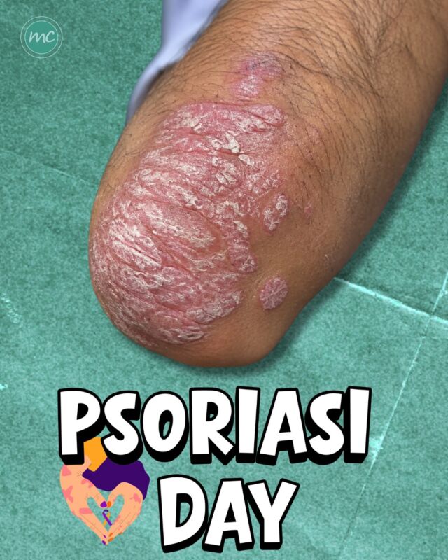 29 OTTOBRE: GIORNATA MONDIALE DELLA PSORIASI 📆
Un'occasione per sensibilizzare su una malattia infiammatoria cronica della pelle, spesso accompagnata da pregiudizi ed informazioni errate.

DI COSA SI TRATTA❓
La PSORIASI è una MALATTIA INFIAMMATORIA CRONICA, immunomediata, che provoca la comparsa di chiazze arrossate ricoperte da squame biancastre.
Può interessare diverse aree del corpo (gomiti, ginocchia, cuoio capelluto, unghie...).

La PSORIASI NON è CONTAGIOSA: non si trasmette attraverso il contatto fisico né condividendo oggetti con una persona che ne è affetta.

La sua origine è multifattoriale e coinvolge il sistema immunitario e una predisposizione genetica. 
Alcuni fattori come stress, infezioni e determinati farmaci, possono favorirne la comparsa o le riacutizzazioni.

COME SI MANIFESTA 🤔
Le manifestazioni più comuni sono chiazze eritematose e desquamanti (talvolta accompagnate da prurito, bruciore o dolore). In alcuni casi possono essere coinvolte anche le unghie e le articolazioni.

SI PUÒ CURARE❓
Non esiste attualmente una cura definitiva ma sono disponibili diversi trattamenti che permettono di controllare la malattia e migliorare così la qualità della vita, tra cui i farmaci biologici: 
terapie avanzate a bersaglio molecolare indicate per il trattamento della psoriasi moderata-severa, in particolare per i pazienti che non rispondono alle cure tradizionali (topiche, sistemiche o fototerapia) o che presentano controindicazioni ad esse.

🚨In caso di dubbi, per qualsiasi alterazione della pelle non esitate a rivolgervi sempre al vostro dermatologo di fiducia !🚨

📍Via Raffaele De Cesare 15, Bari
📞 𝟥𝟩𝟨 𝟣𝟣𝟧𝟣𝟪𝟤𝟨 (acne) / 𝟥𝟦𝟪 𝟨𝟣𝟢𝟥𝟦𝟨𝟣
☎️ 𝟢𝟪𝟢 𝟩𝟫𝟨𝟥𝟥𝟦𝟫

#dottssamarinaconese #dermatologia #casoclinico #bari #puglia #influencer #new