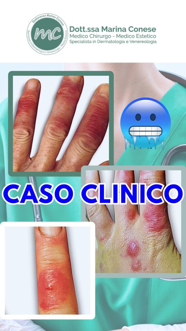 CON L'ARRIVO DEL FREDDO, POSSONO COMPARIRE QUESTE LESIONI… ❄️👀

Arrossamento, gonfiore e una colorazione rossastra o violacea. Spesso accompagnati da prurito, bruciore e talvolta dolore. 

Sono manifestazioni che interessano soprattutto le dita delle mani e dei piedi e che possono accentuarsi durante i mesi più freddi...

DI COSA SI TRATTA❓
L'avete vissuta in prima persona ? Conoscete qualcuno a cui è capitato? 
Scrivetelo nei commenti 👇

📍Via Raffaele De Cesare 15, Bari
📞 𝟥𝟩𝟨 𝟣𝟣𝟧𝟣𝟪𝟤𝟨 (acne) / 𝟥𝟦𝟪 𝟨𝟣𝟢𝟥𝟦𝟨𝟣
☎️ 𝟢𝟪𝟢 𝟩𝟫𝟨𝟥𝟥𝟦𝟫

#dottssamarinaconese #dermatologia #casoclinico #influencer #bari #puglia #new