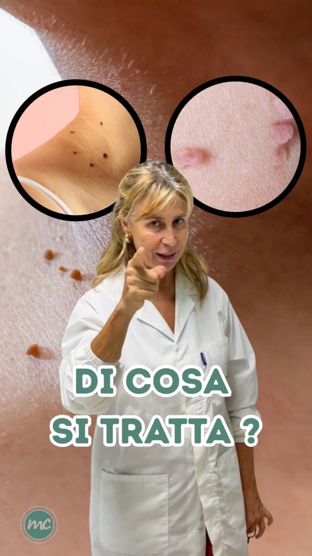 Una lesione di tipo penducolato, morbida, del colore della cute o iperpigmentato...

DI COSA SI TRATTA❓
Sono dei FIBROMI PENDULI, piccole lesioni benigne costituite da tessuto fibroso lasso che si localizzano più frequentemente sui lati del collo e nelle pieghe cutanee, come ascelle e inguine. Si presentano come escrescenze morbide e peduncolate.

Come le rimuovo ? Ve lo spiego nel reel 👀

📍Via Raffaele De Cesare 15, Bari
📞 𝟥𝟩𝟨 𝟣𝟣𝟧𝟣𝟪𝟤𝟨 (acne) / 𝟥𝟦𝟪 𝟨𝟣𝟢𝟥𝟦𝟨𝟣
☎️ 𝟢𝟪𝟢 𝟩𝟫𝟨𝟥𝟥𝟦𝟫

#dottssamarinaconese #dermatologia #influencer #bari #puglia #new