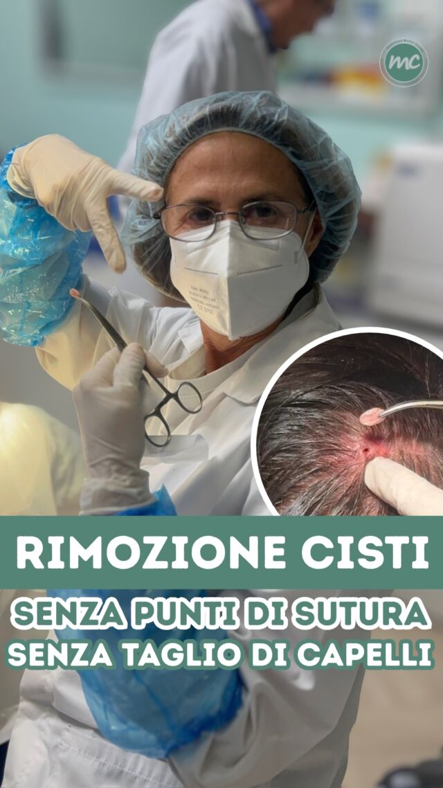 CONCLUDIAMO LA SETTIMANA CON UNA RIMOZIONE CISTI💥

Questa ragazza è giunta in Studio direttamente da Napoli. Cosa l'ha convinta ? L'aver visto i miei video sui social.
Una bella dimostrazione di come possano accorciare le distanze, far conoscere il proprio lavoro e creare un rapporto di fiducia ancor prima che incontrarsi di persona. ❤️

COME L'HO RIMOSSA❓Sempre con il mio metodo chirurgico minimamente invasivo e quindi :

- SENZA tricotomia (no taglio di capelli)🚫✂️
- SENZA punti di sutura 🚫🪡

Vi aspetto qui in Studio !

PROCEDURE TERAPEUTICHE INNOVATIVE PERCORSO ACNE E RIMOZIONE CISTI SEBACEE DOTT.SSA MARINA CONESE™️

📍Via Raffaele De Cesare 15, Bari
📞 𝟥𝟩𝟨 𝟣𝟣𝟧𝟣𝟪𝟤𝟨 (acne) / 𝟥𝟦𝟪 𝟨𝟣𝟢𝟥𝟦𝟨𝟣
☎️ 𝟢𝟪𝟢 𝟩𝟫𝟨𝟥𝟥𝟦𝟫

#dottssamarinaconese #dermatologia #new #cisti #influencer #bari #puglia